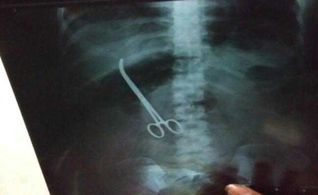 डॉक्टरों ने सर्जरी के दौरान महिला के पेट में छोड़ी चिमटी, तीन महीने बाद हुआ खुलासा