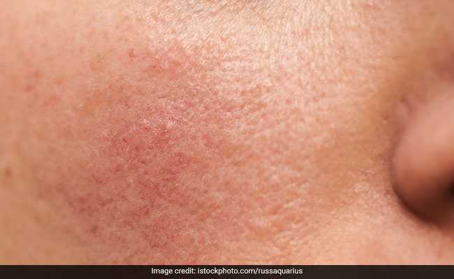 Rosacea usually affects people with fair skin
