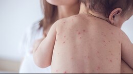 Measles Outbreak In United States: Signs And Symptoms Of Measles To Look Out For