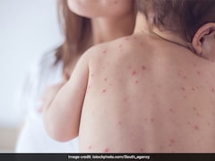 Measles Outbreak In Texas: What We Know So Far