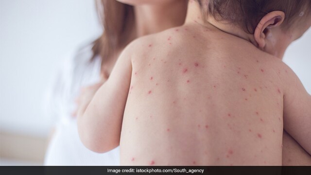 Measles Outbreak In US: Understanding What Is Vitamin A Toxicity