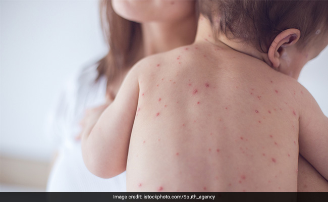 Measles Outbreak In United States: Signs And Symptoms Of Measles To Look Out For