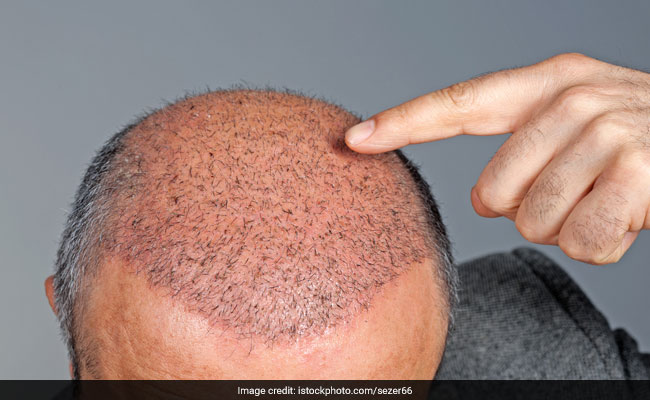 एक्सपर्ट से जानिए क्यों हेयर ट्रांसप्लांट करवाना हो सकता है खतरनाक, कुछ बातों का ध्यान रखना है जरूरी