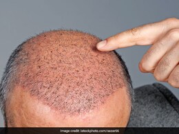 Hair Transplant: एक्सपर्ट से जानें  हेयर ट्रांसप्लांट से क्यों घबराते हैं ज्यादातर लोग? जानें रोज कितने बाल झड़ना है सेफ Hair Transplant: एक्सपर्ट से जानें  हेयर ट्रांसप्लांट से क्यों घबराते हैं ज्यादातर लोग? जानें रोज कितने बाल झड़ना है सेफ