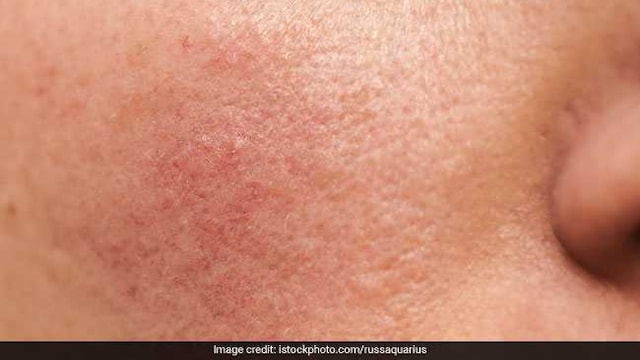 Hormonal imbalance can lead to hormonal acne