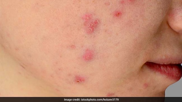 Avoid bursting pimples to prevent acne scars