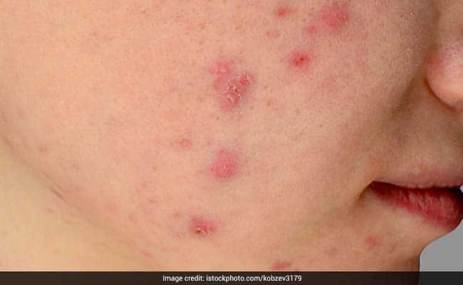 Using These Combination Therapies Can Help Heal Acne