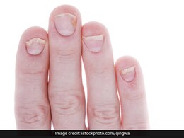 कोलेस्ट्रॉल बढ़ने पर हाथों में दिखते हैं ये 5 बदलाव, इन संकेतों को पहचान घर बैठे लगा सकते हैं High Cholesterol का पता कोलेस्ट्रॉल बढ़ने पर हाथों में दिखते हैं ये 5 बदलाव, इन संकेतों को पहचान घर बैठे लगा सकते हैं High Cholesterol का पता