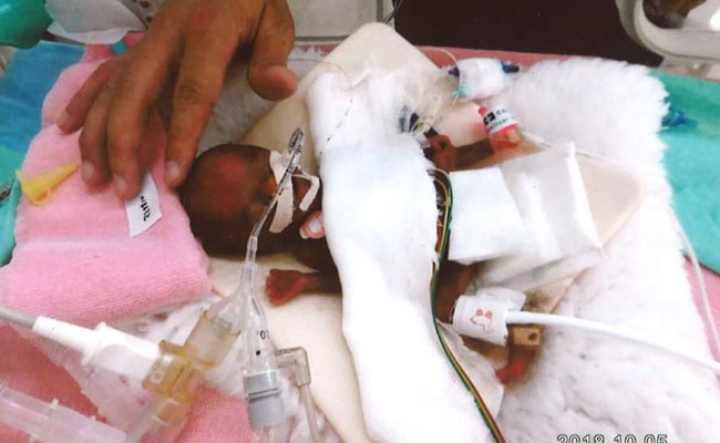 This Is World's Smallest Baby Boy, Weighing As Much As Apple