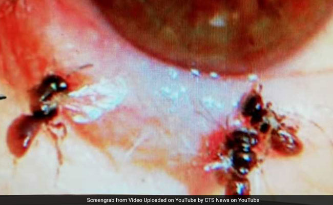 Doctors Find 4 Live Bees Inside Woman's Eye, Feeding On Her Tears