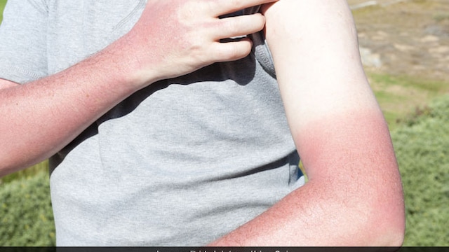 The UV rays of the sun and scorching heat can make your skin oily.
