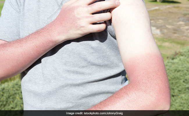 The UV rays of the sun and scorching heat can make your skin oily.