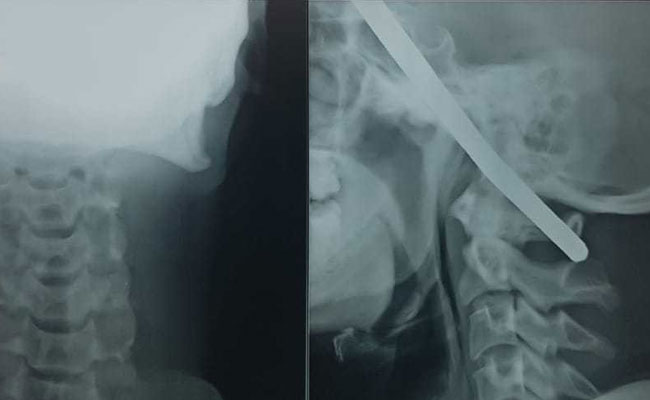 Iron Rod Pierced Through Construction Worker's Head. He Survived
