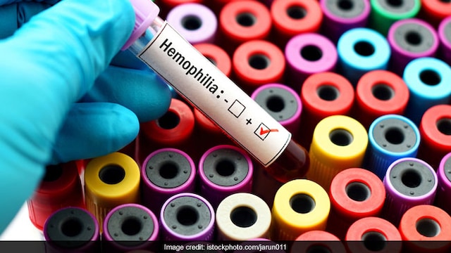 World Hemophilia Day 2021: It is an inherited bleeding disorder that prevents blood clotting