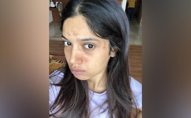 कैरेक्टर की खातिर बिगड़ गया इस बॉलीवुड एक्ट्रेस का चेहरा, अब बचा है बस यही एक रास्ता