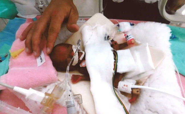 इस बच्चे का वजन है Apple के बराबर, मां का दूध पिलाने के लिए होता है रुई का इस्तेमाल