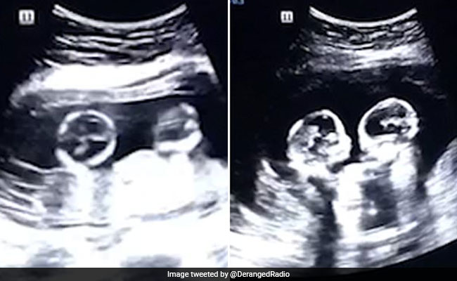 मां के पेट के अंदर हुई जुड़वे बच्चों की लड़ाई, वायरल हुआ VIDEO
