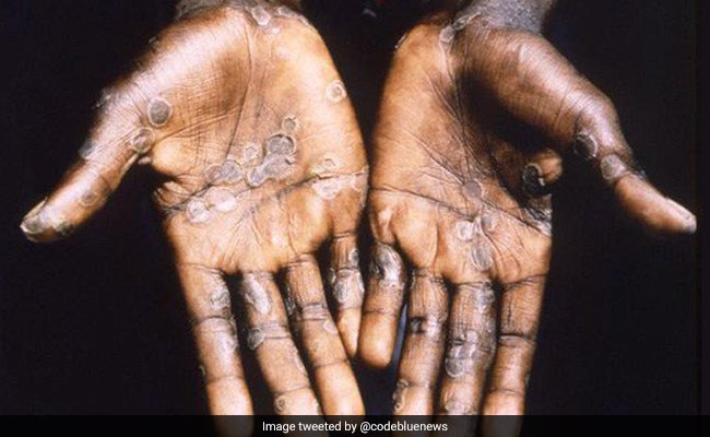 Tamil Nadu Government Issues Directives To Monitor Monkeypox Cases