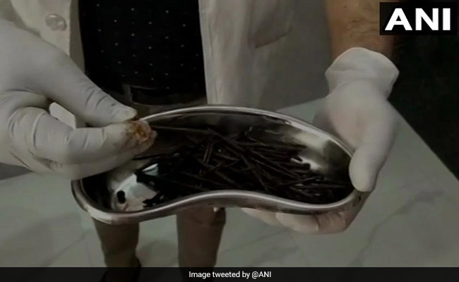 116 Iron Nails, Wire Removed From Man's Stomach In Rajathan's Bundi