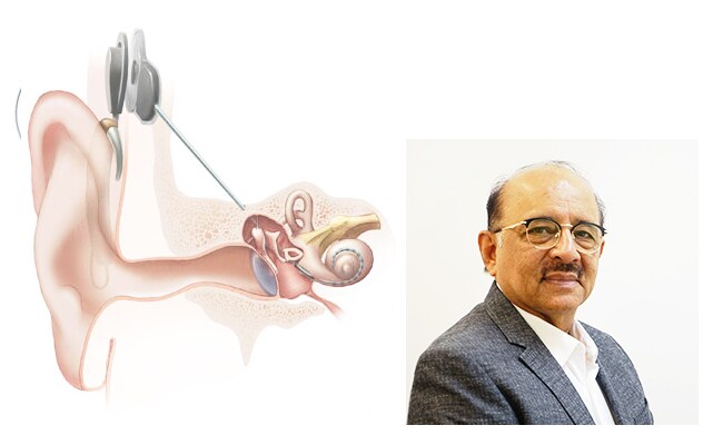காக்லியர் இம்பிளான்ட் சிகிச்சை: செவித்திறன் குறைபாடுள்ளவர்களுக்கு எப்படி உதவுகிறது? காக்லியர் இம்பிளான்ட் சிகிச்சை: செவித்திறன் குறைபாடுள்ளவர்களுக்கு எப்படி உதவுகிறது?