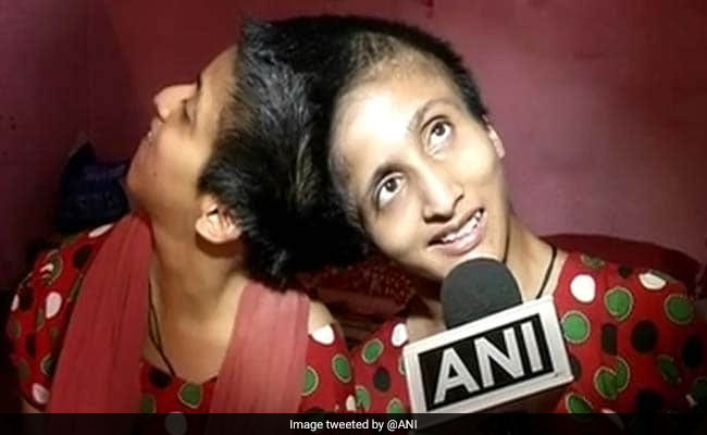 Patna Conjoined Twins Now Hold Individual Voting Rights