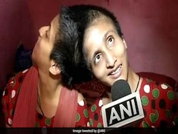 Patna Conjoined Twins Now Hold Individual Voting Rights Patna Conjoined Twins Now Hold Individual Voting Rights