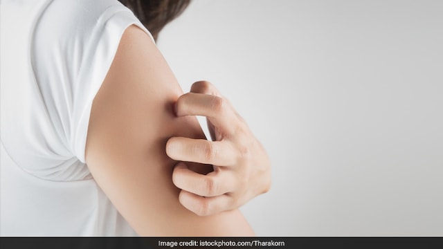 Avoid foods that cause acne on skin during summer