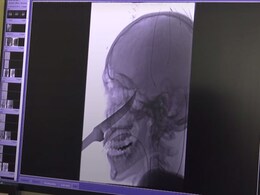 Video: Doctors Remove Ten-Inch Knife That Impaled Teenager's Face Video: Doctors Remove Ten-Inch Knife That Impaled Teenager's Face