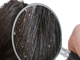 बालों में डैंड्रफ से होती है खुजली और सिर दिखता है सफेद, तो ये 5 तरीके Dandruff दूर करने में करेंगे आपकी मदद  बालों में डैंड्रफ से होती है खुजली और सिर दिखता है सफेद, तो ये 5 तरीके Dandruff दूर करने में करेंगे आपकी मदद