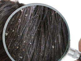 डैंड्रफ में दही के अलावा इन 6 चीजों को भी लगा सकते हैं बालों पर, रूसी का नामोंनिशान मिट जाएगा 