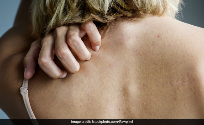 Retired Nurse Who Couldn't Stop "Clawing" Herself Feared Liver Transplant