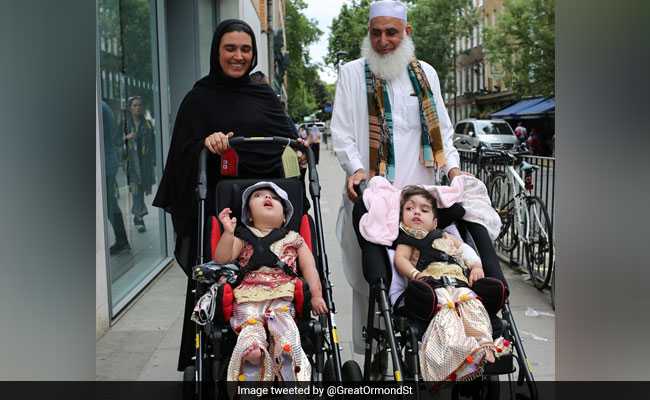 2-Year-Old Pak Twins, Joined At Head, Separated In London Hospital