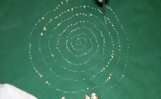 चेन्नई के डॉक्टरों ने पांच घंटे की सर्जरी के बाद 7 साल के बच्चे के मुंह से निकाले 526 दांत, जानें पूरा मामला