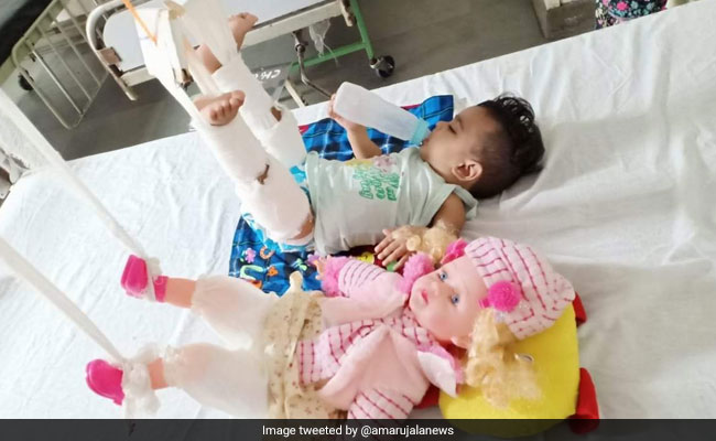 To Treat 11-Month-Old's Fracture, Doctors First Had To Plaster Her Doll