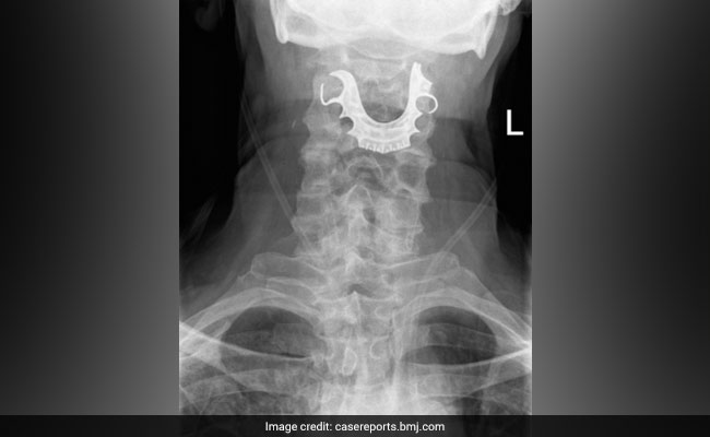 British Man's Dentures Disappeared, Found Stuck In Throat 8 Days Later