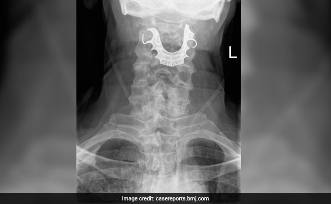 आदमी के गले में फंस गए नकली दांत, हफ्ते बाद कैमरा डालकर देखा तो डॉक्टर रह गए हैरान
