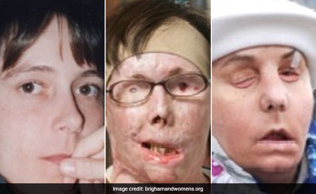 Woman Fights For A Third Face As Body Rejects Transplant