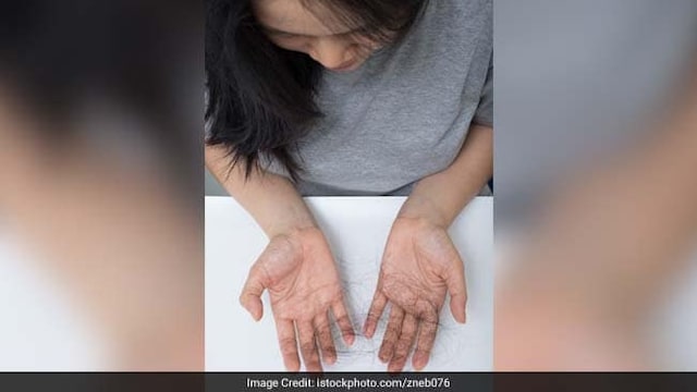Iron deficiency, which causes hair loss, may go undetermined for years