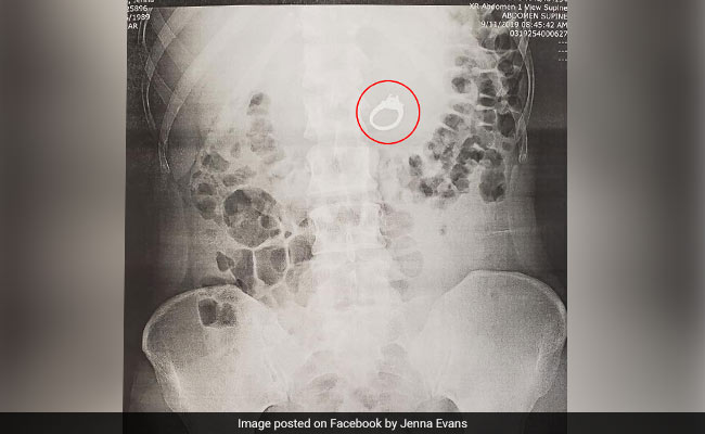 महिला ने सपने में निगली शादी की अंगूठी, उठी तो उंगली देखकर रह गई हैरान