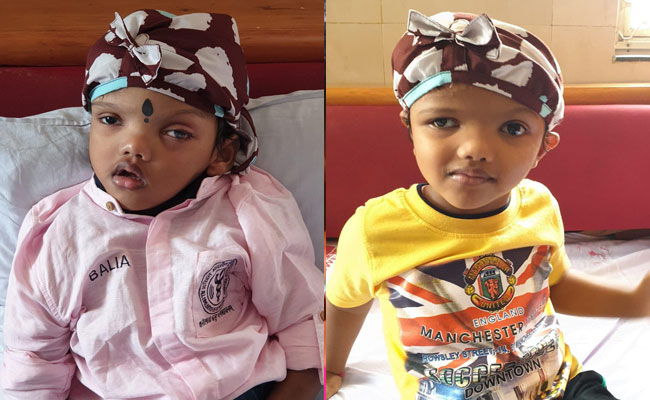 सिर से जुड़े जग्गा और बलिया जटिल सर्जरी के जरिए अलग होने के बाद स्वस्थ, एम्स से हुए डिस्चार्ज