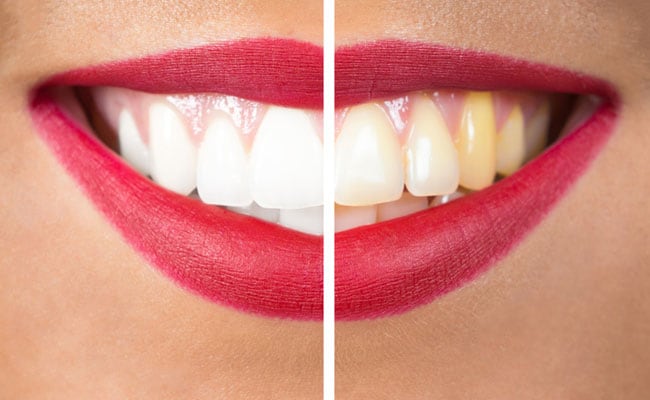 Teeth Whitening Tips: दांतों के पीलेपन से हैं परेशान आजमाएं ये घरेलू नुस्खे, मोतियों से चमकने लगेगें आपके दांत