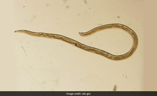 Woman Jogs Through Flies, Pulls 4 Worms From Her Eye A Month Later