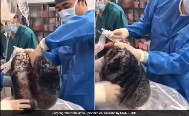 Shocking Video Shows Lungs Blackened By 30 Years Of Smoking