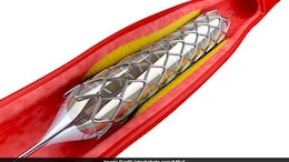 What Should You Avoid After A Stent Implant? Cardiologist Shares Tips For A Healthy Heart