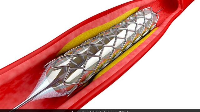 Coronary stent is a tiny mesh tube that is put into a heart artery