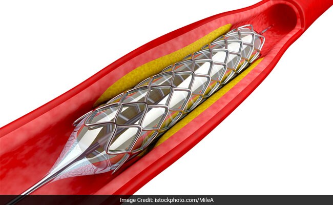 Coronary stent is a tiny mesh tube that is put into a heart artery