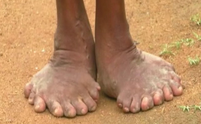 "Called A Witch," Says Odisha Woman Born With 20 Toes, 12 Fingers
