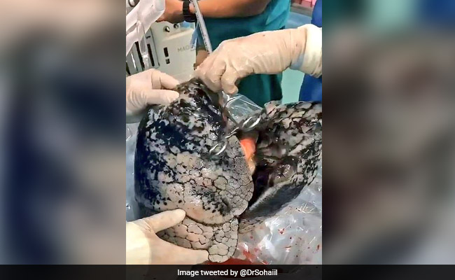धूम्रपान करने वाले शख्स ने दान किए फेफड़े, डॉक्टरों ने Video में दिखाया लंग्स का हाल