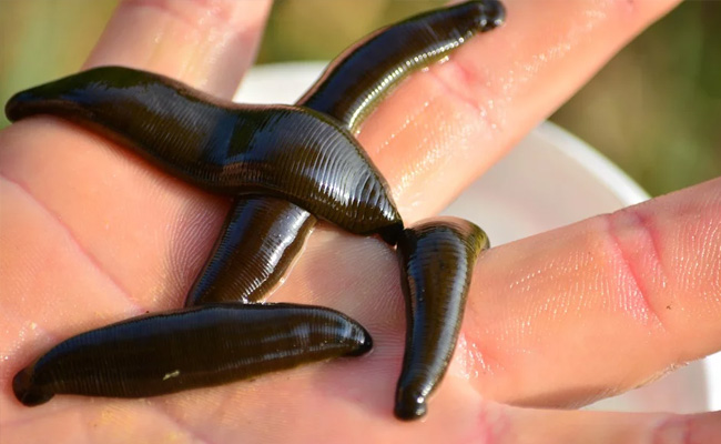 Man Coughing Non-Stop For 2 Months Had Live Leeches Stuck To Throat