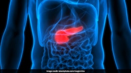Fatty Pancreas Detected In Nearly 50% Of Type 2 Diabetes Patients, Finds Study